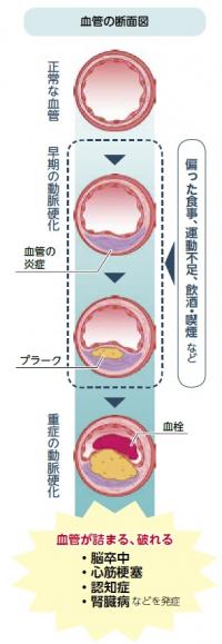 症状毎の血管の断面図（図解）