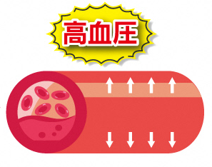 高血圧の状態の血管のイラスト